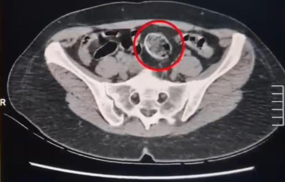 Kars'ta İran uyruklu 2 şüpheli, vücutlarında 307,94 gram metamfetaminle tutuklandı