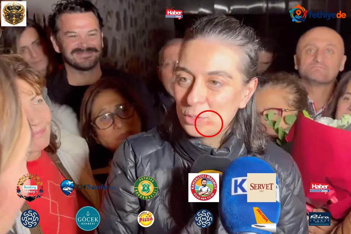 Sinem Dedetaş'ın dudağının kenarındaki kızarıklığın nedeni belli oldu
